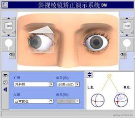 斜視測試|斜視檢測